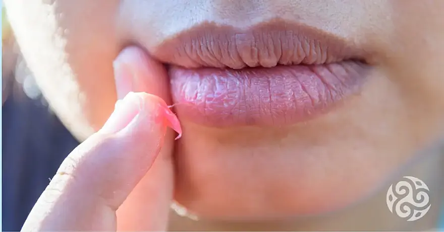 Rozpraskané nebo suché rty? Jaké jsou příčiny a co může pomoci